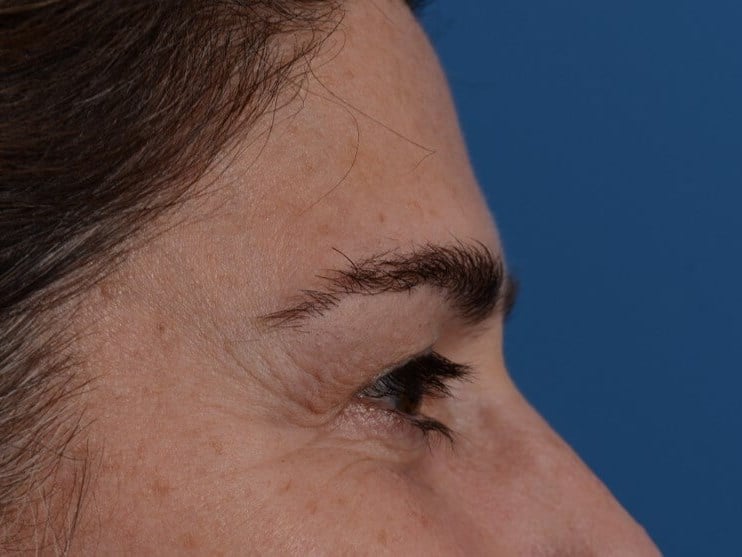 Upper Eyelid Lift Before