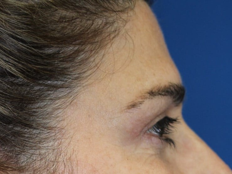 Upper Eyelid Lift After