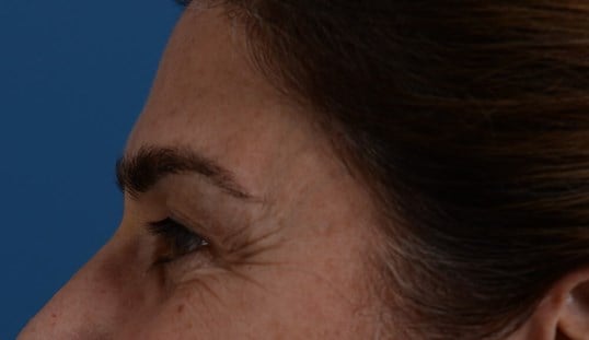 Upper Eyelid Lift Before