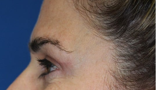 Upper Eyelid Lift After