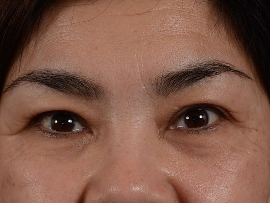 Upper Eyelid Lift Before