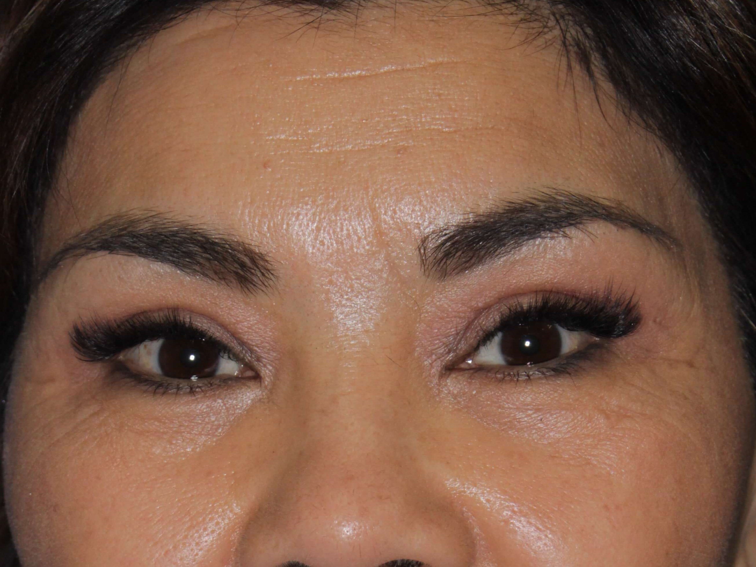Upper Eyelid Lift After