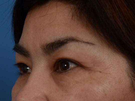 Upper Eyelid Lift Before