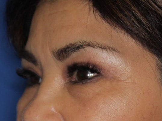 Upper Eyelid Lift After