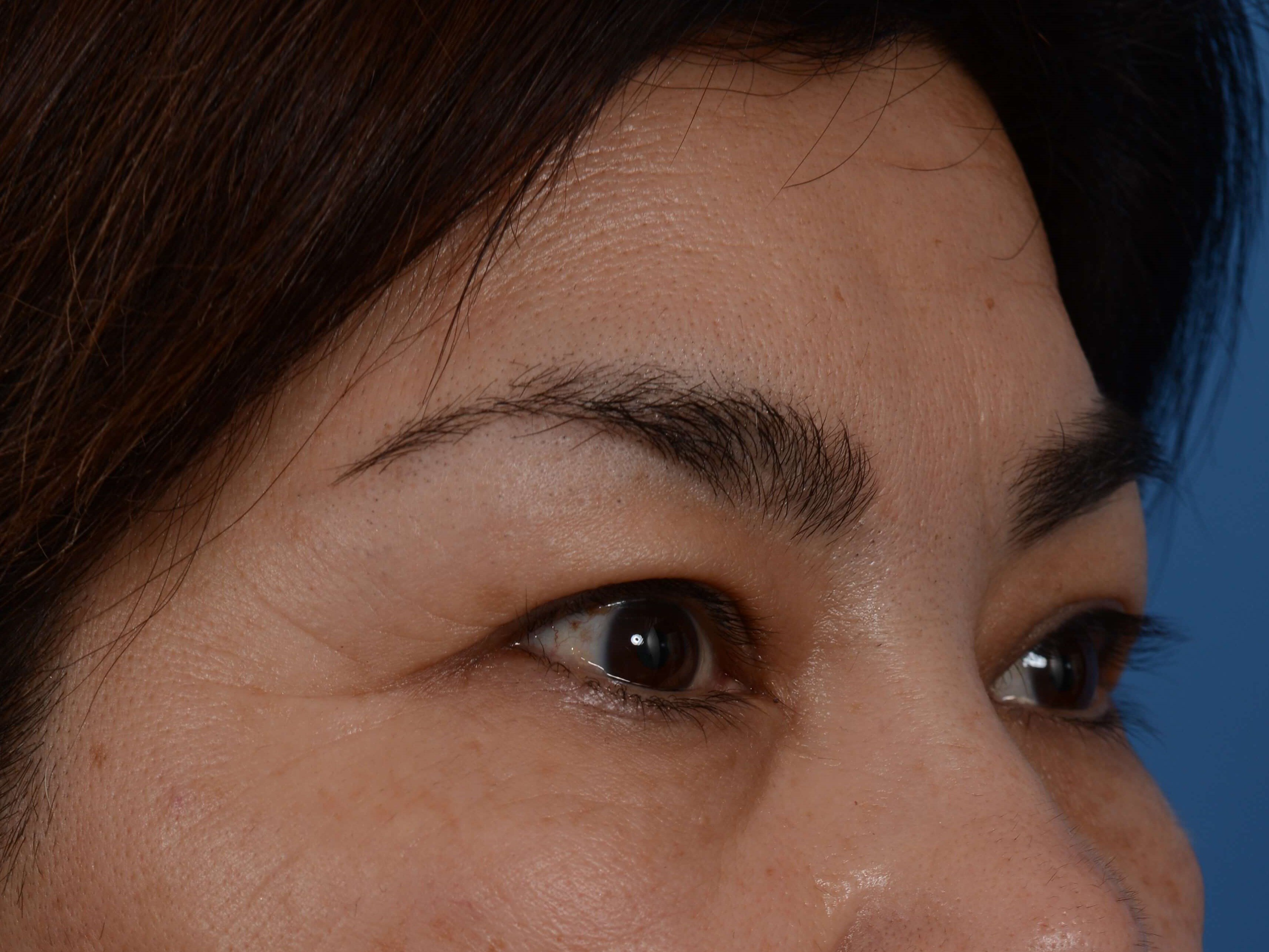 Upper Eyelid Lift Before