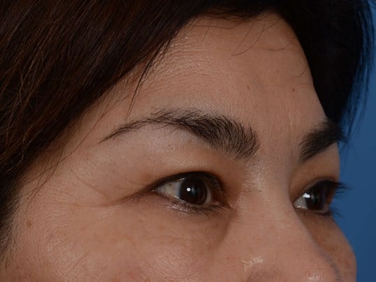 Upper Eyelid Lift Before