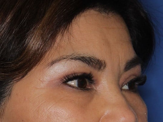 Upper Eyelid Lift After