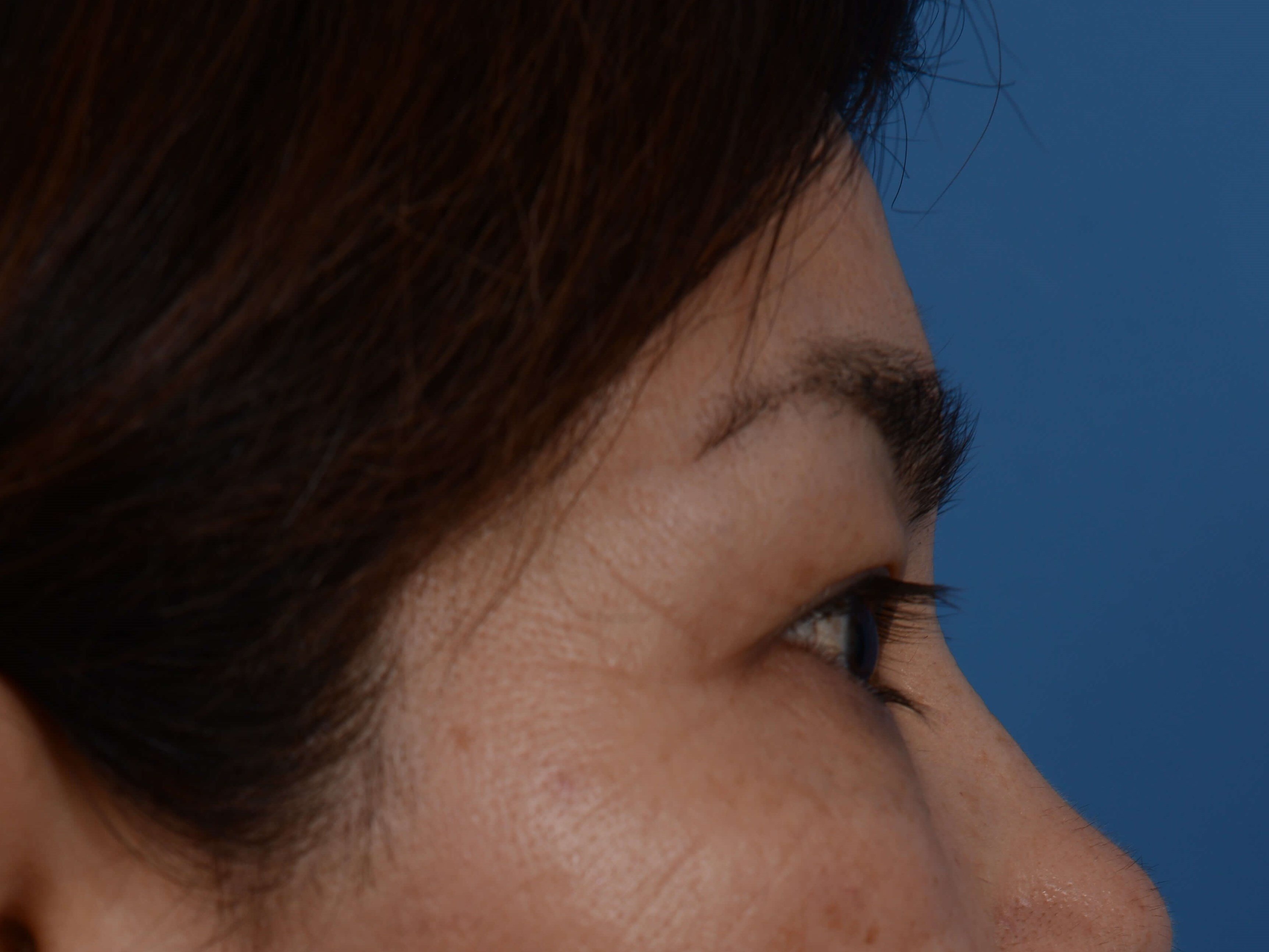 Upper Eyelid Lift Before