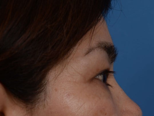 Upper Eyelid Lift Before