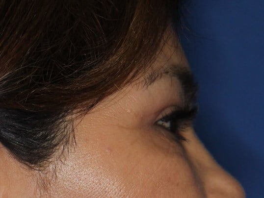 Upper Eyelid Lift After
