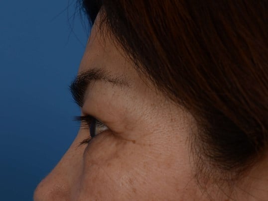 Upper Eyelid Lift Before