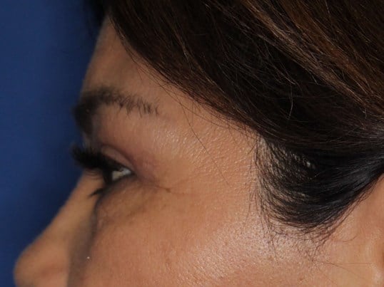 Upper Eyelid Lift After