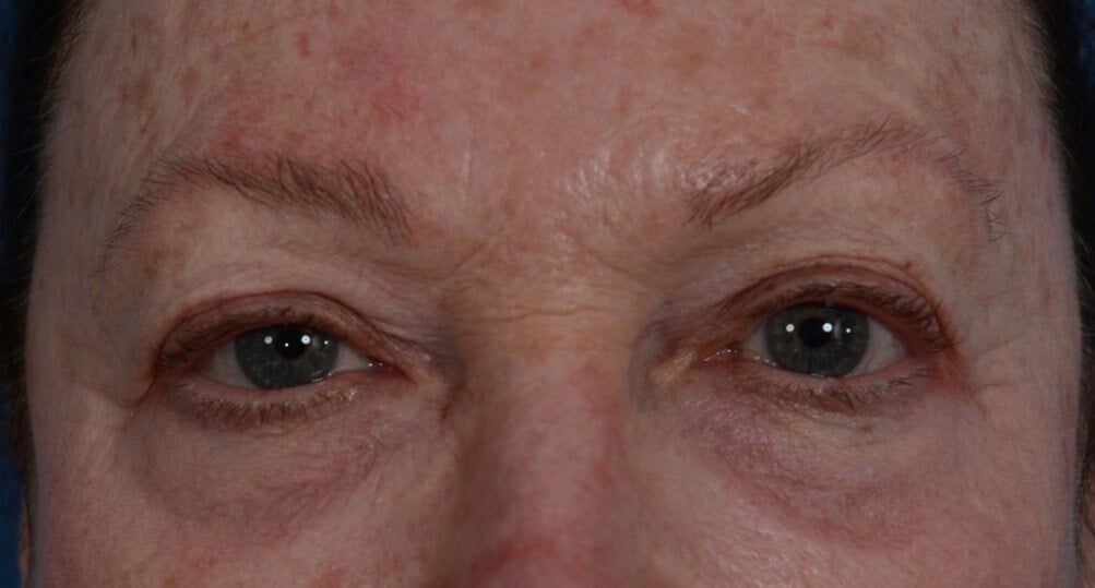 Upper Eyelid Lift Before