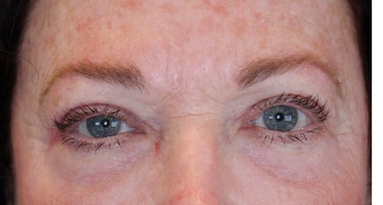 Upper Eyelid Lift After