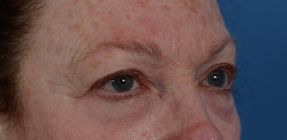Upper Eyelid Lift Before
