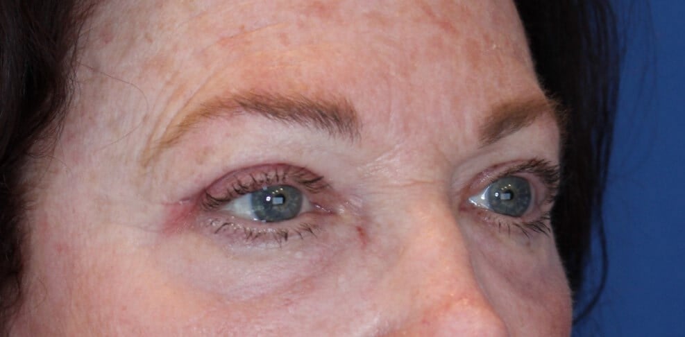 Upper Eyelid Lift After