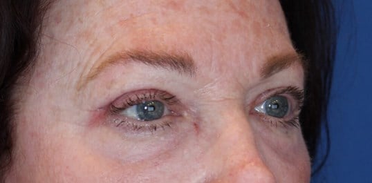 Upper Eyelid Lift After