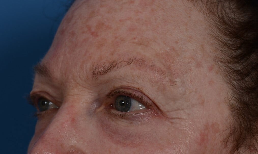 Upper Eyelid Lift Before