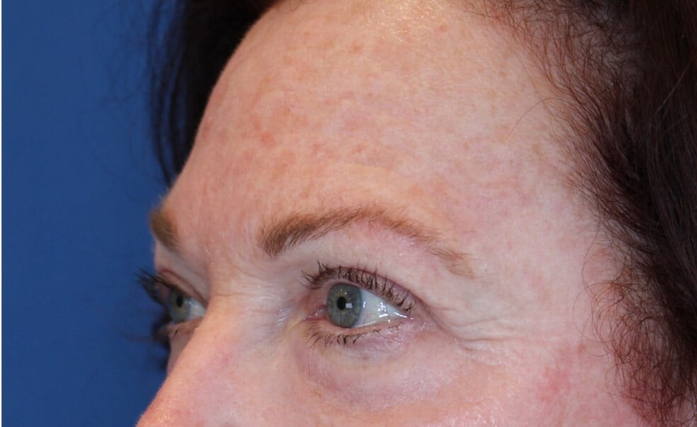 Upper Eyelid Lift After
