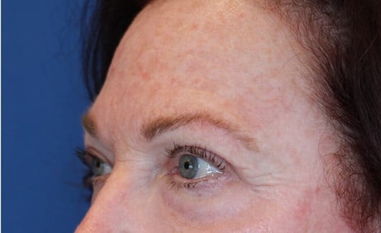 Upper Eyelid Lift After