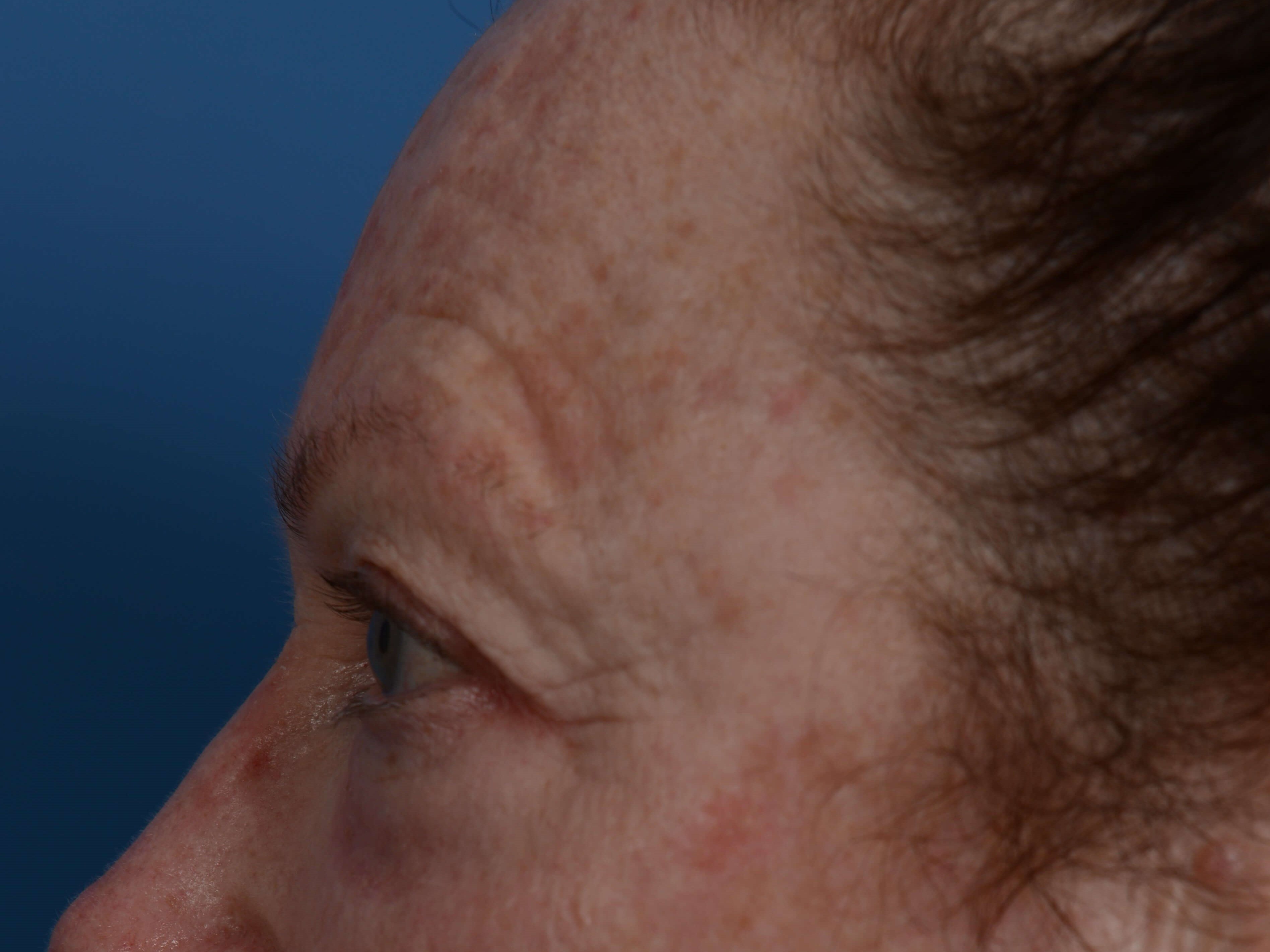 Upper Eyelid Lift Before