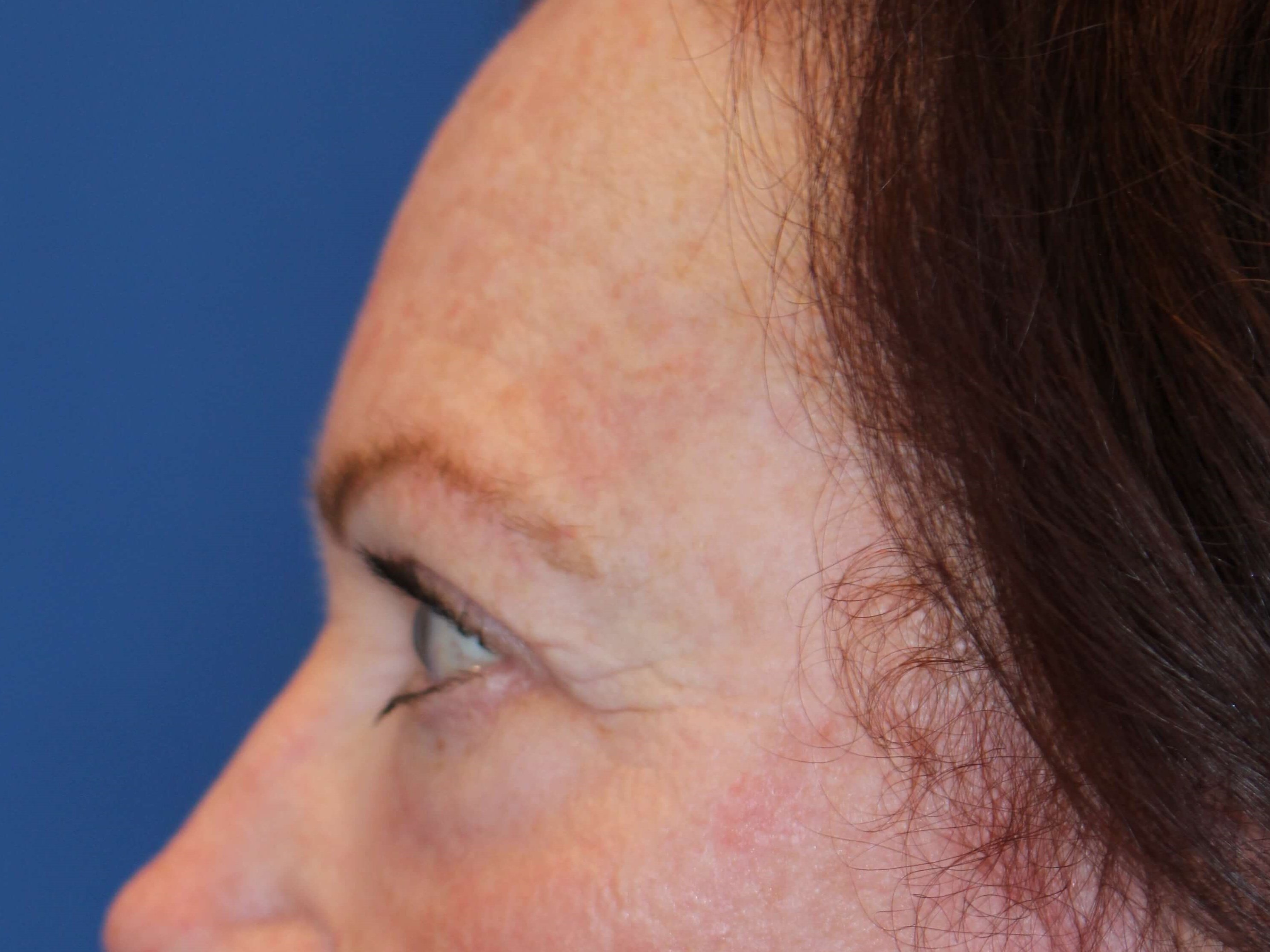 Upper Eyelid Lift After