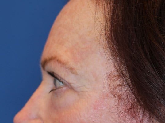 Upper Eyelid Lift After