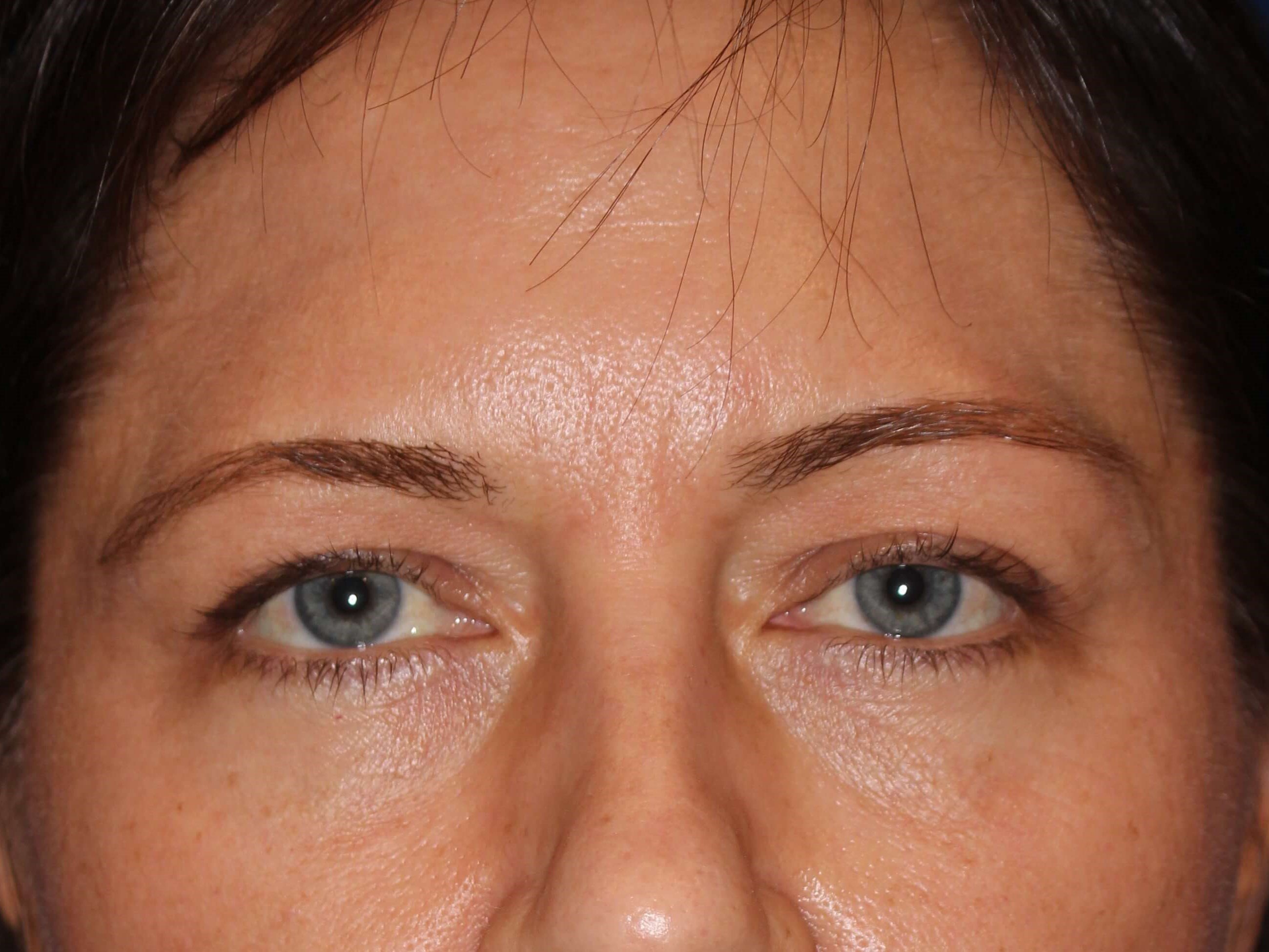 Upper Eyelid Lift Before
