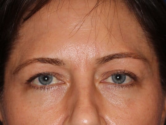 Upper Eyelid Lift Before