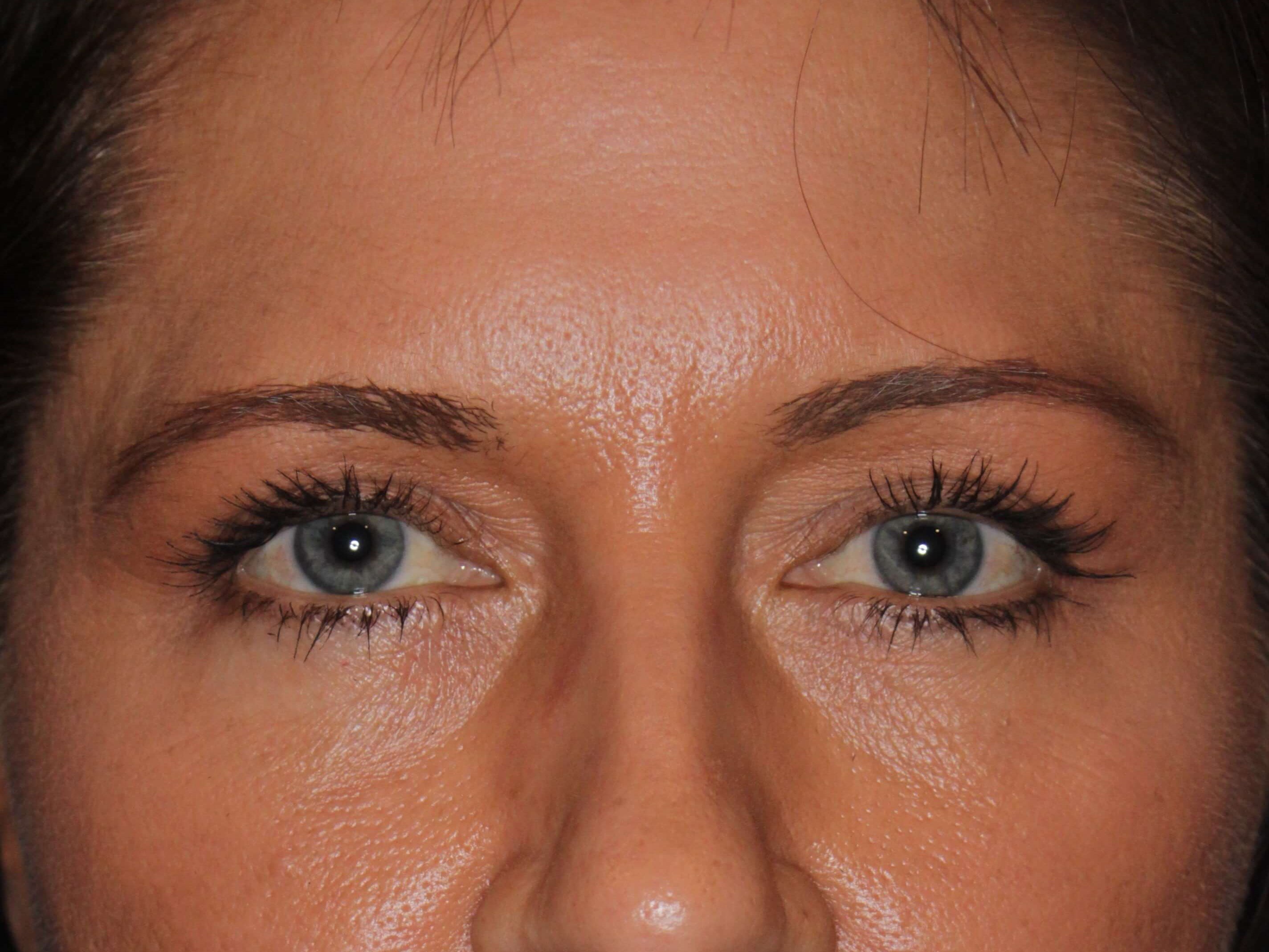 Upper Eyelid Lift After