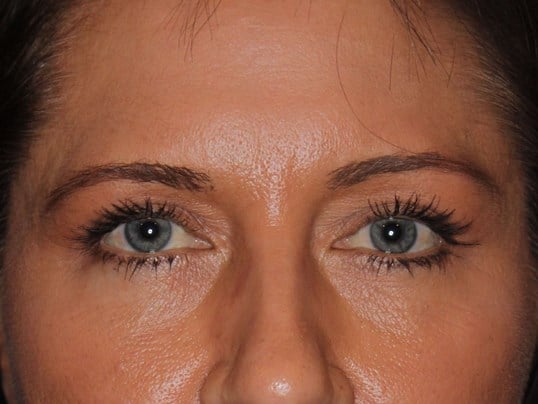 Upper Eyelid Lift After