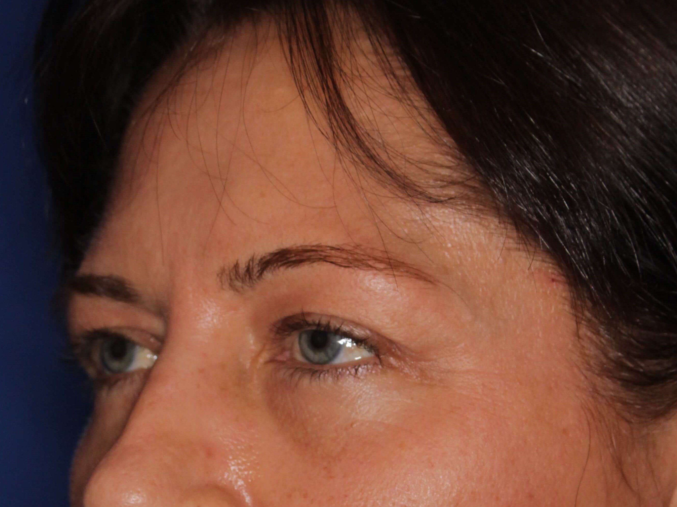 Upper Eyelid Lift Before