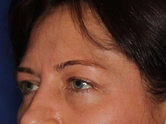 Upper Eyelid Lift Before