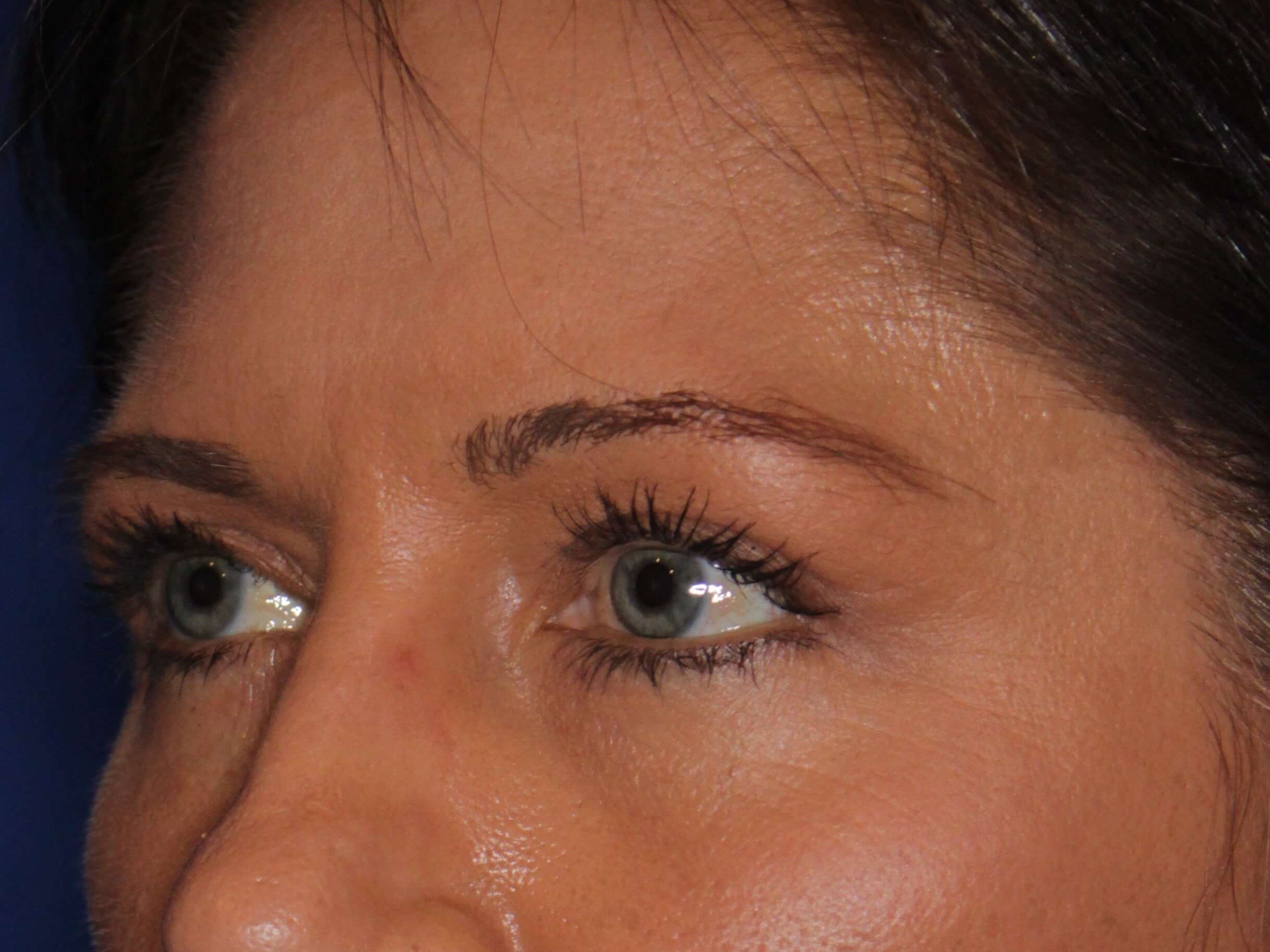 Upper Eyelid Lift After