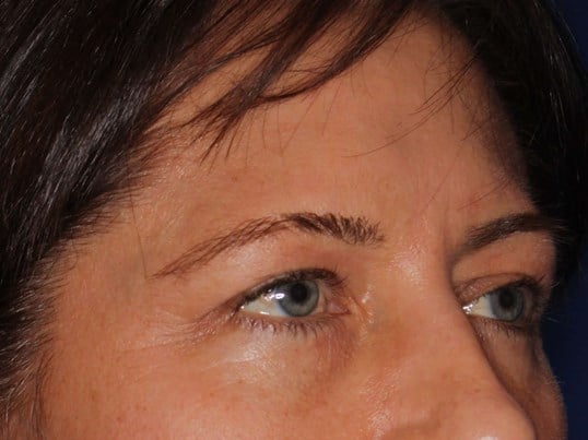 Upper Eyelid Lift Before