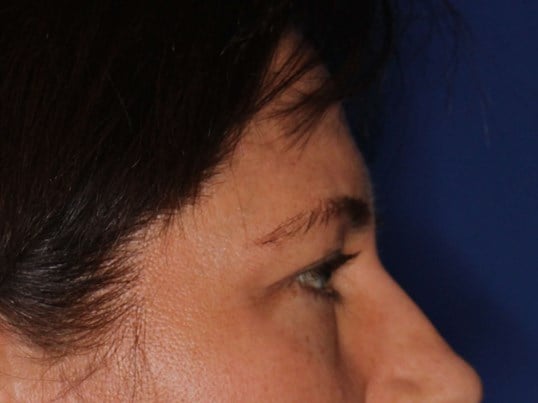 Upper Eyelid Lift Before