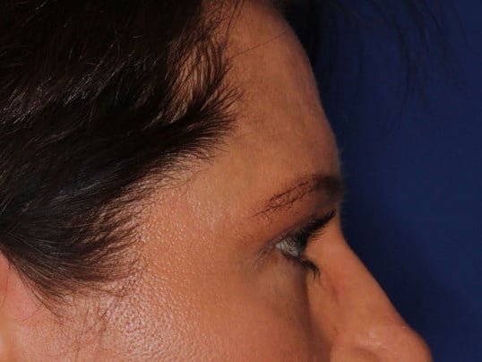 Upper Eyelid Lift After