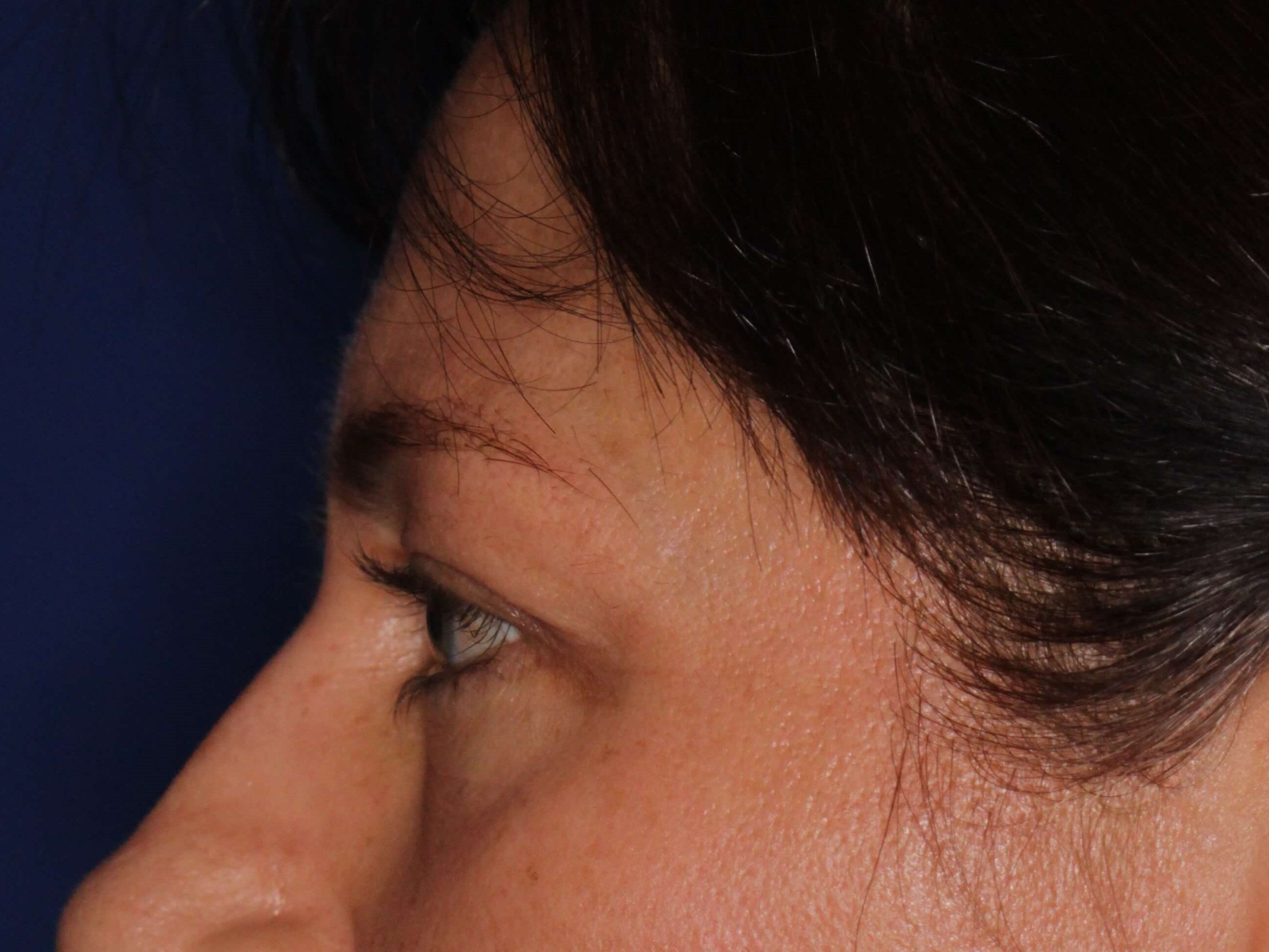 Upper Eyelid Lift Before