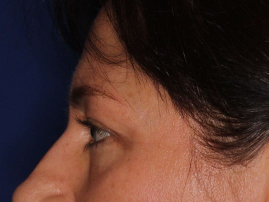 Upper Eyelid Lift Before