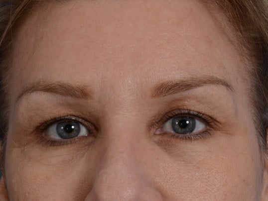 Upper Eyelid Lift Before