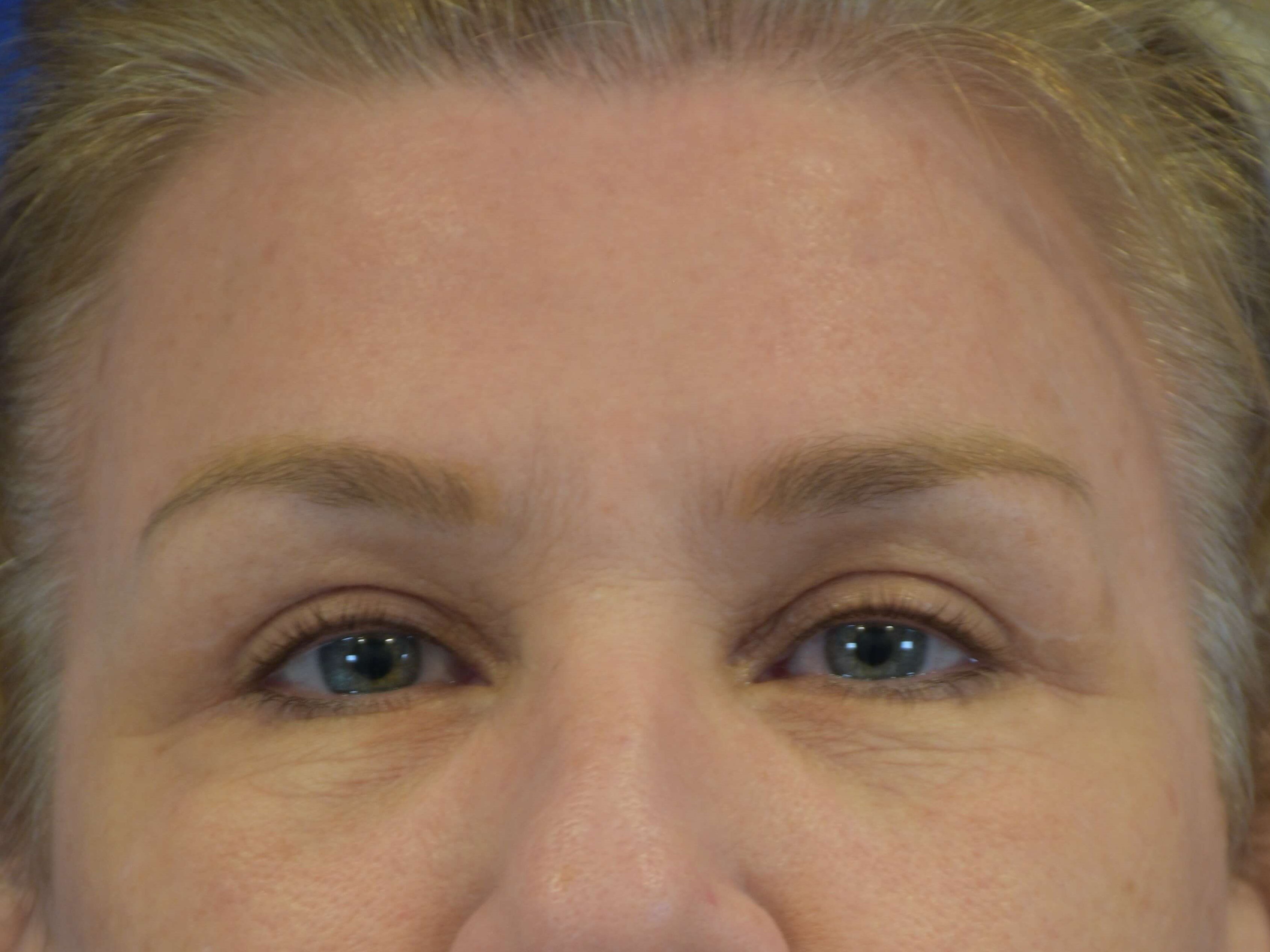 Upper Eyelid Lift After