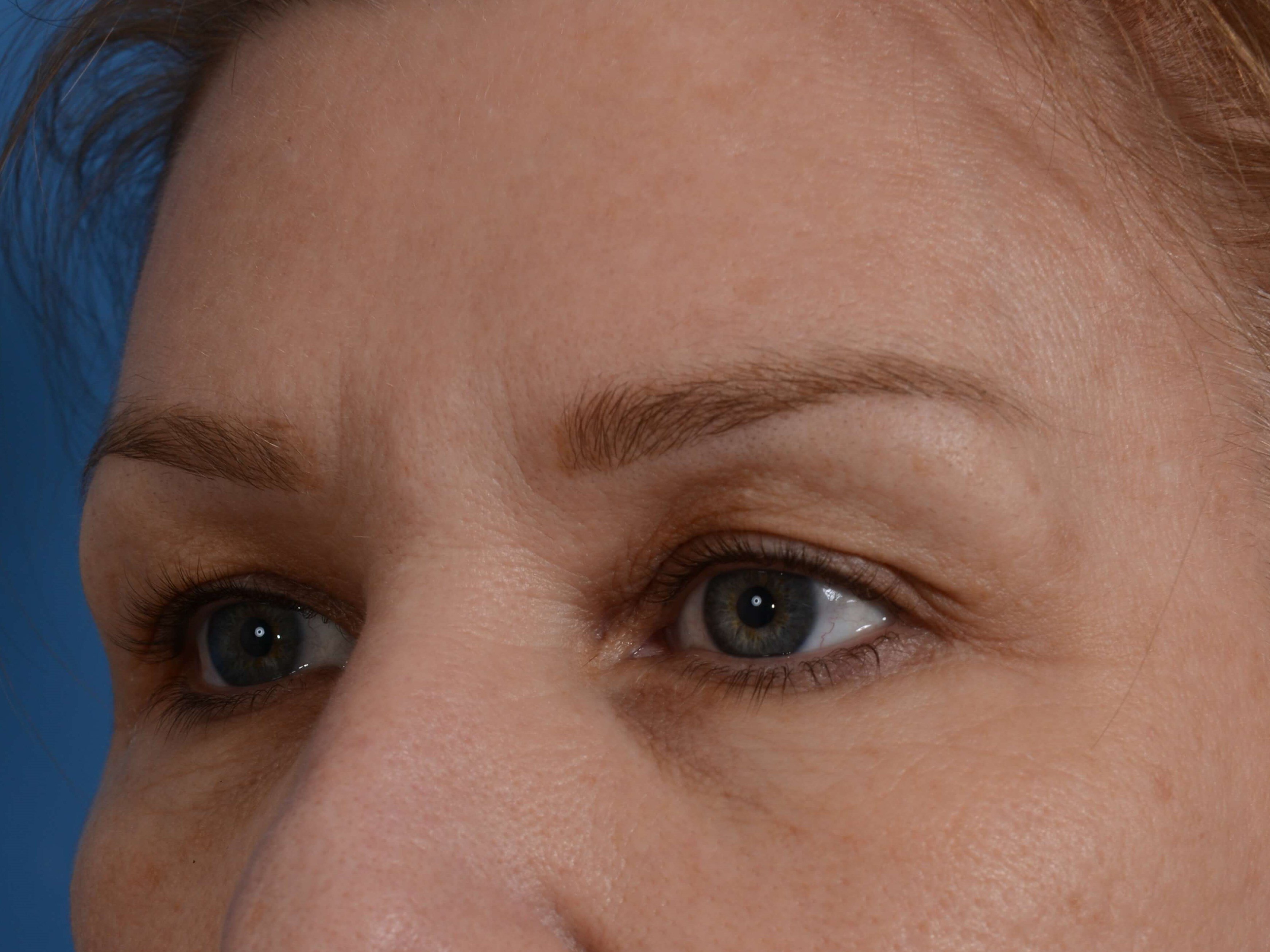 Upper Eyelid Lift Before