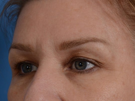 Upper Eyelid Lift Before