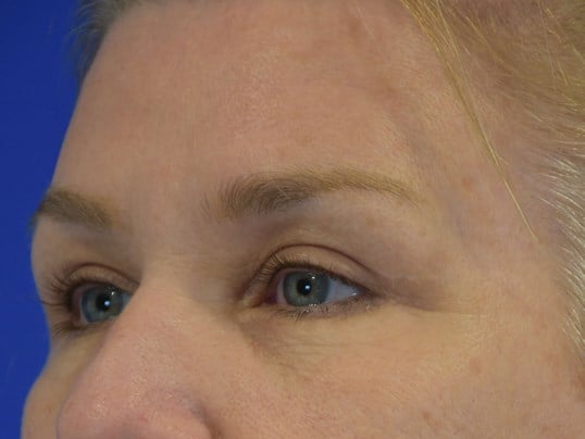 Upper Eyelid Lift After