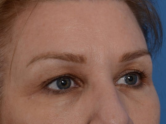 Upper Eyelid Lift Before