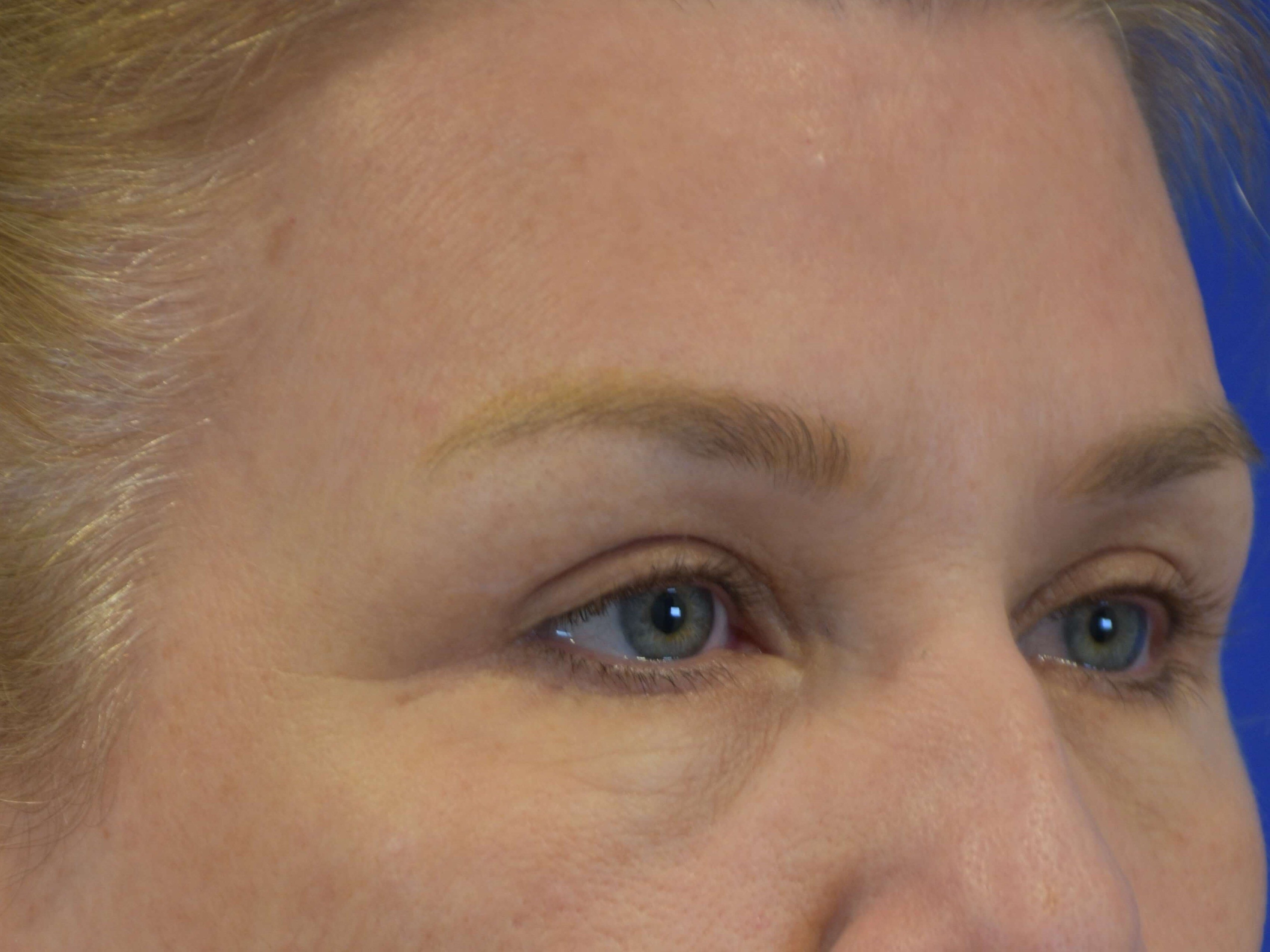 Upper Eyelid Lift After