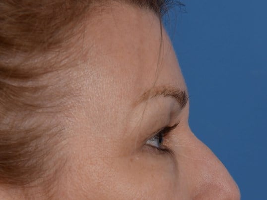 Upper Eyelid Lift Before