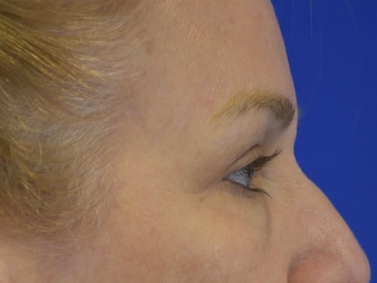 Upper Eyelid Lift After