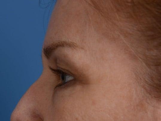 Upper Eyelid Lift Before