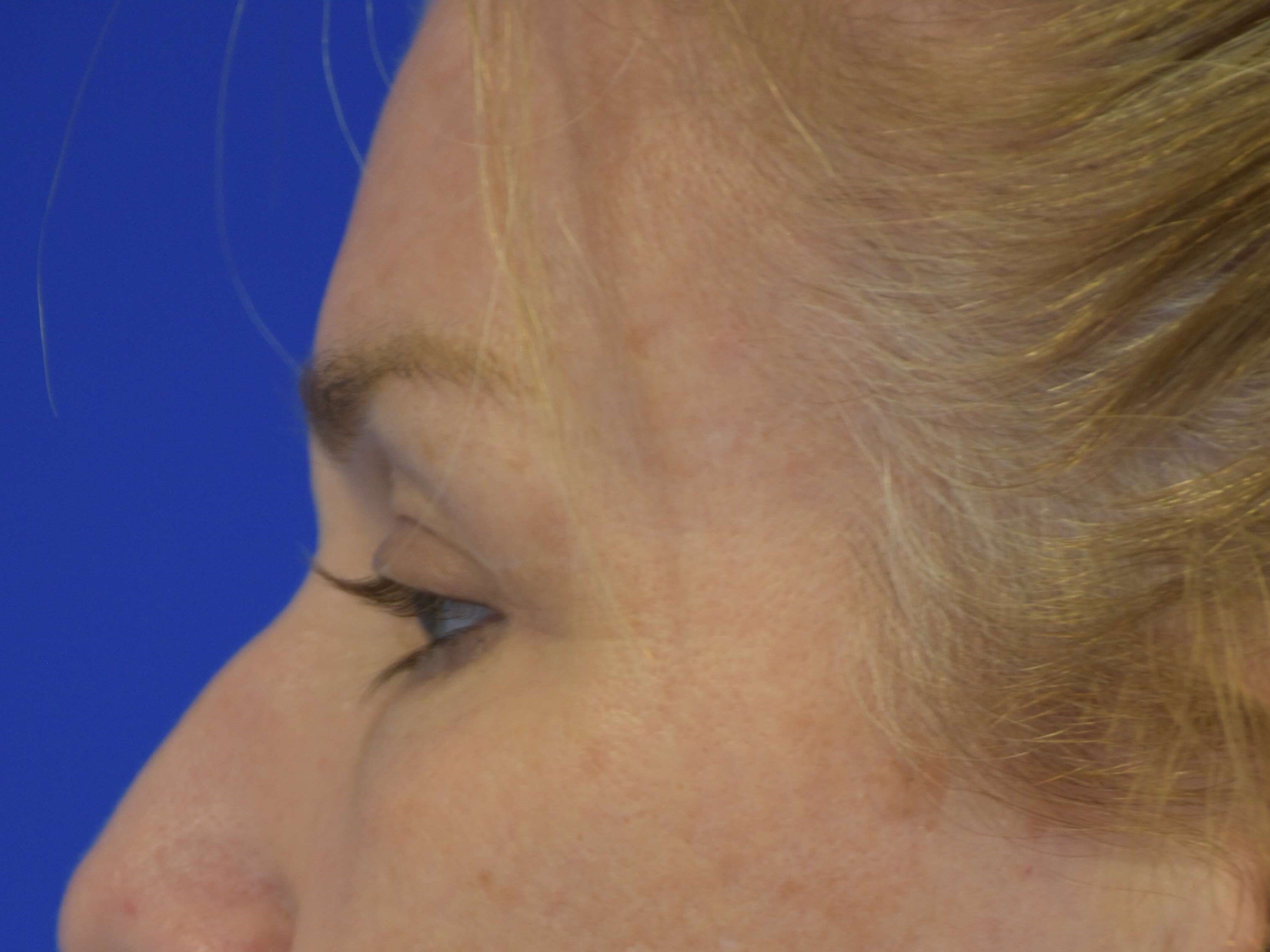 Upper Eyelid Lift After